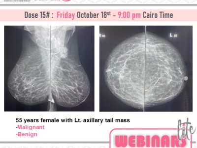 Dose #14 Breast metastasis Dr. Nevien Fares